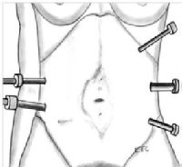 Pohled  při laparoskopické operaci